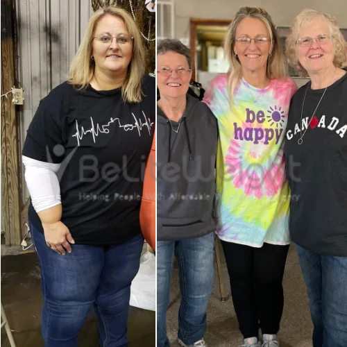 RNY Gastric Bypass Surgery Before and after